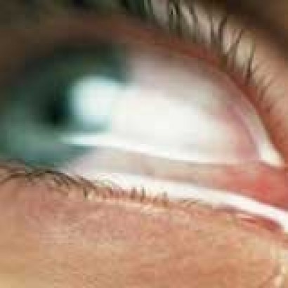 توصیه‌هایی برای مبتلایان به حساسیت‌های چشمی بهاره