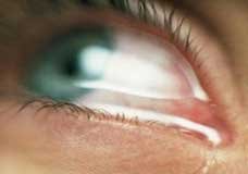 توصیه‌هایی برای مبتلایان به حساسیت‌های چشمی بهاره