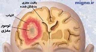 فکر کردن باعث افزایش رشد تومور مغزی می‌شود!