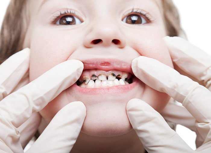 شاخص پوسیدگی دندان دانش آموزان را به عدد یک کاهش خواهیم داد