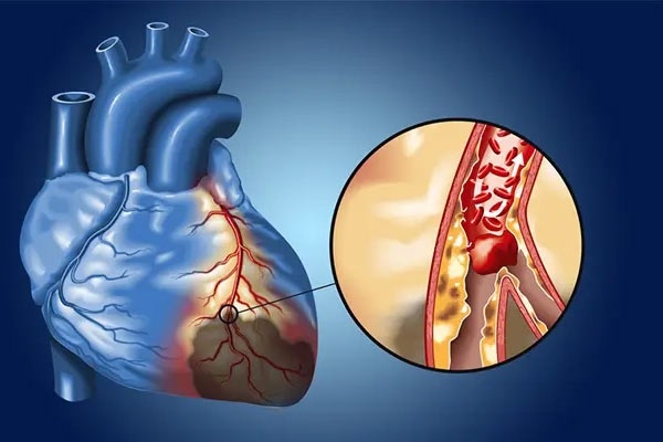 ECG هوشمند؛ گامی جدید در پیشگیری از سکته قلبی